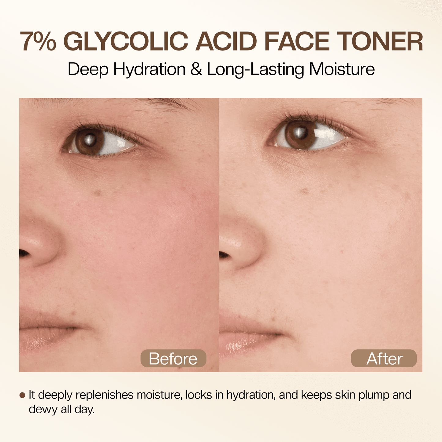 Glycolic Acid Toner: 240ml Glycolic Acid 7% Exfoliating Toner Toning Solution Which Soothes and Hydrates Skin